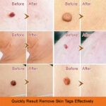 Wart Spot Nevus Remover Cream Painless Mole Dark Spot Warts Remover Serum Freckle Face Wart Tag Treatment Removal Essential Oil - Image 5