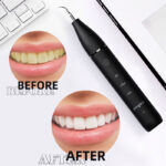 Sonic Electric Dental Plaque Remover - Image 5